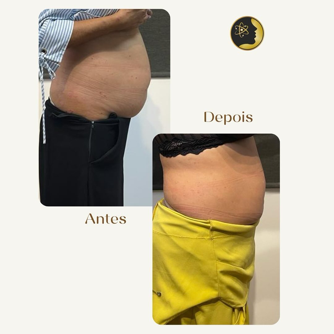 Antes e depois